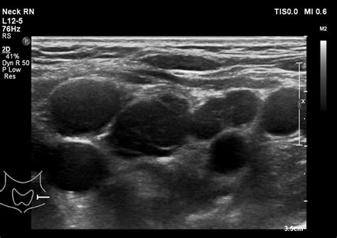 Lymphoma Action Ultrasound Scan