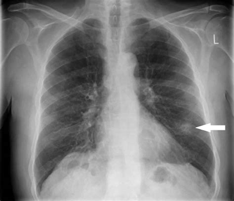 Solitary Pulmonary Nodule Definition Causes Symptoms Diagnosis