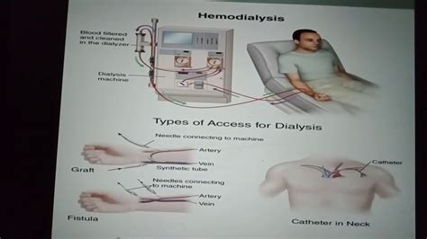 Types Of Dialysis Youtube