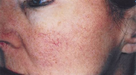 Rid Your Skin Of Age Spots And Lesions With Our Photofacials