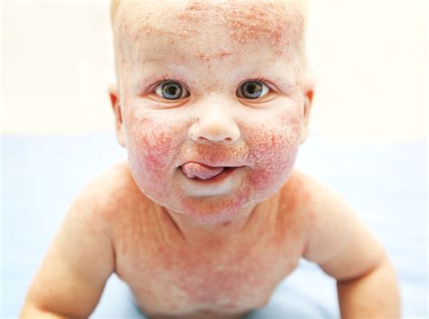Contact Dermatitis Baby Food Murray Hanks