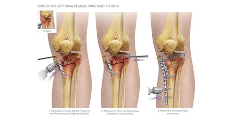 Tibial Plateau Fracture Surgery