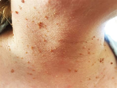 12 Bumps On Your Skin That Are Totally Normal—and You Shouldnt Pop