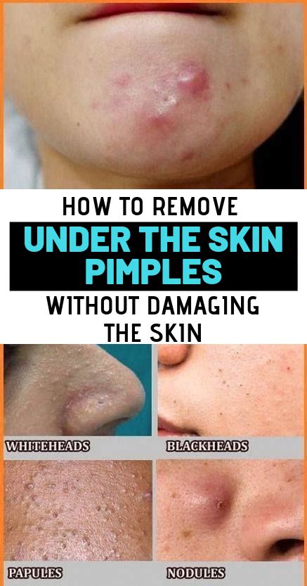 How To Remove Under The Skin Pimples Without Damaging Your Skin With