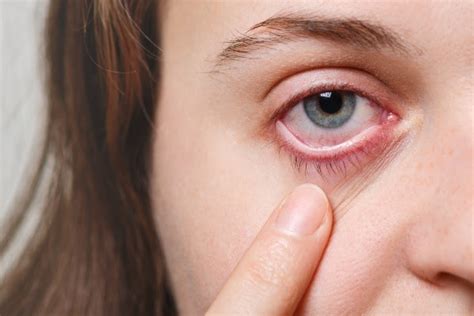 Derrame Ocular Causas Sintomas E Tratamento Mundoboaforma Hot Sex Picture