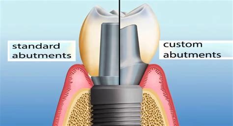 Individual And Standard Abutments Features And Benefits
