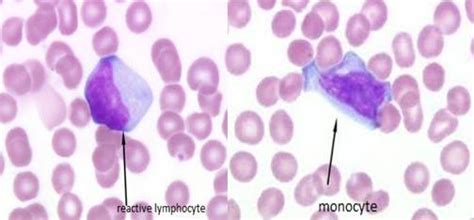 Monocyte And Reactive Lymphocyte 504×234 Hematología