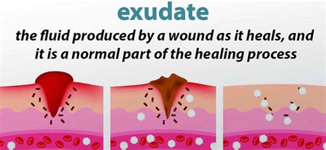 Exudate Definition Types And Difference Between Transudate And Exudate