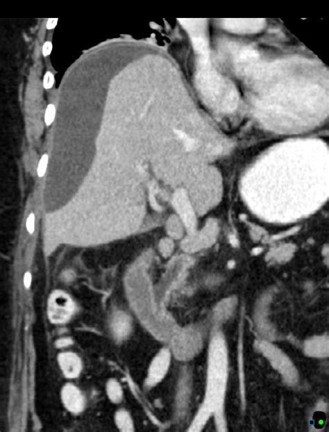Perforated Gallbladder With Subcapsular Biloma Image