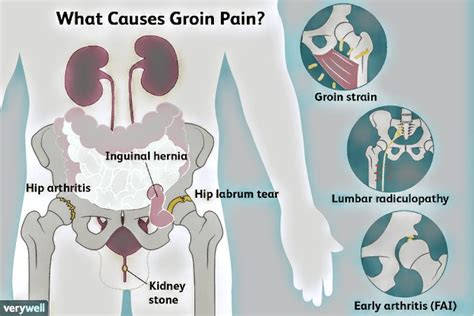 Causes Of Groin Pain In Males Pt Master Guide