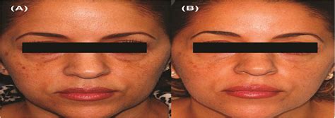 Successful Treatment Of Under Eye Pigmentation In Skin Type