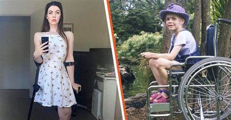 model who lost leg to bone cancer is accused of faking her disability for attention