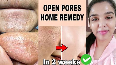 No More Clogged Open Pores Remove Large Pores Clogged Pores
