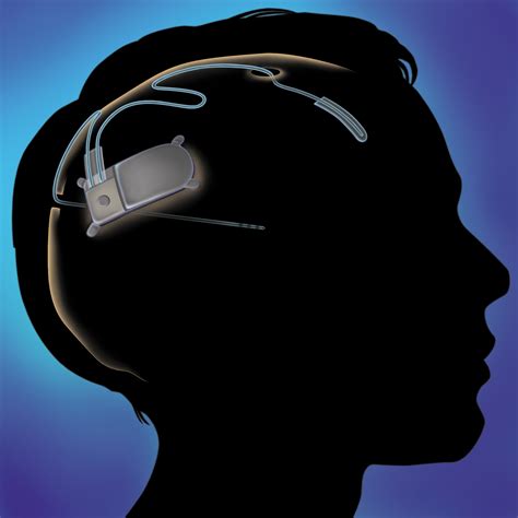 New Medical Device Treats Epilepsy With A Well Timed Zap Shots