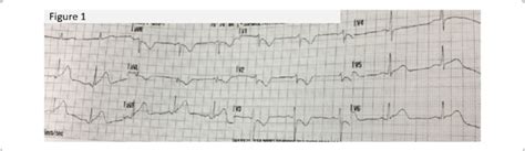 12 Lead Electrocardiogram Ecg Showing Posterior Inferior Stemi