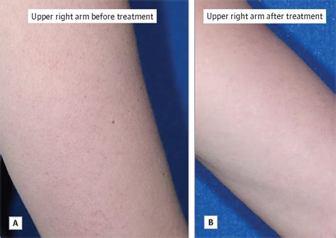 Keratosis Pilaris Treatment With Diode Laser Dermatology Jama