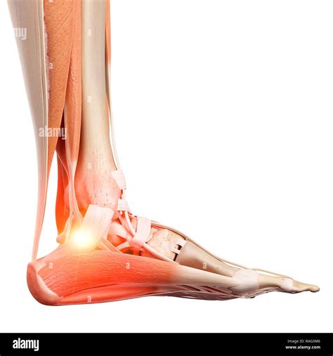 Illustration Of A Painful Ankle Stock Photo Alamy