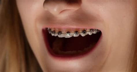Girl Opens Her Mouth Teeth With Braces People Stock Footage Ft Angry And Braces Dental Envato