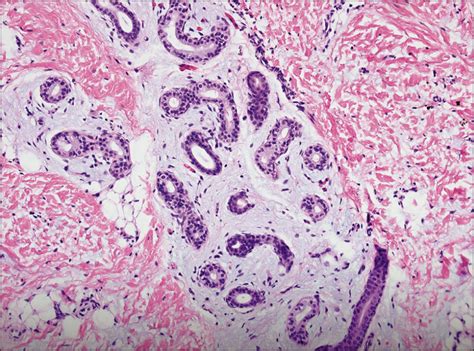 Congenital Mucinous Eccrine Nevi In An Infant With Chronic