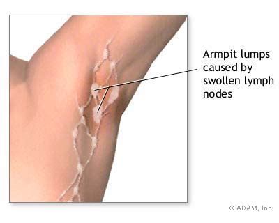 The New York Times Health Image Swollen Lymph Nodes Under Arm