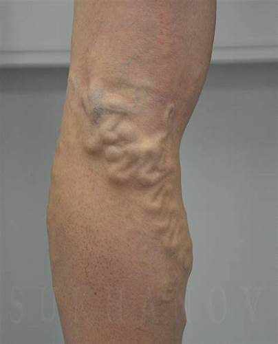 Варикоз ног ⋆ варикозные вены ⋆ Флеболог Суханов Картинка - Варикоз ног ⋆ варикозные вены ⋆ Флеболог Суханов