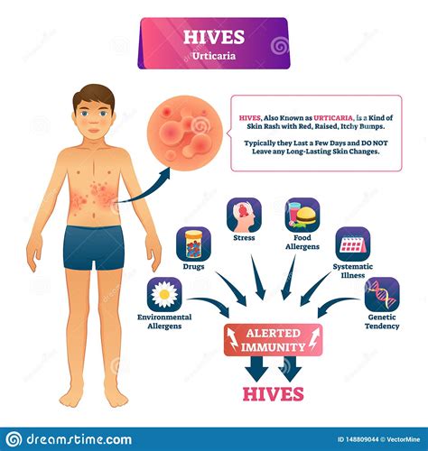 Hives Urticaria Vector Illustration Labeled Skin Rash Explanation