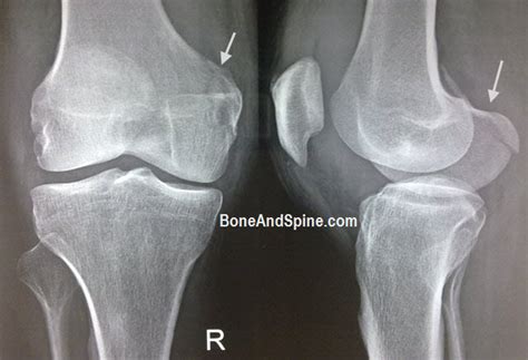 Medial Femoral Condyle Insufficiency Fracture