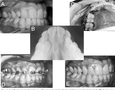 Figure 1 From Surgical And Orthodontic Management Of Impacted Anterior