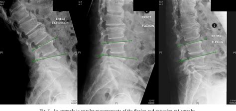 Slump Sitting X Ray Of The Lumbar Spine Is Superior To The Conventional