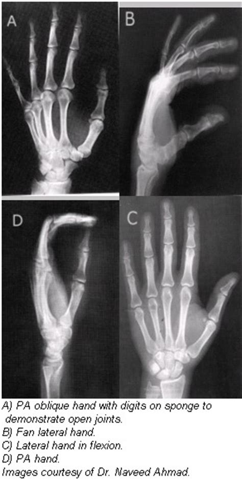 Hand X Rays The Superpower Supertool Cia Medical