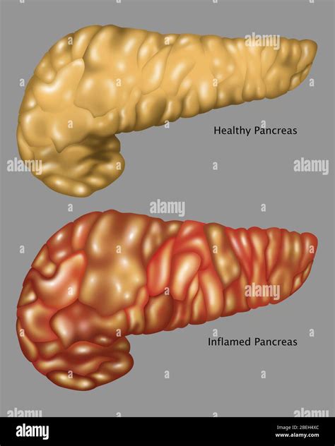 Pancreas Illustration Healthy And Inflamed Stock Photo Alamy