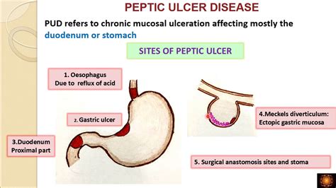 Peptic Ulcer Disease Drvshanthi Youtube