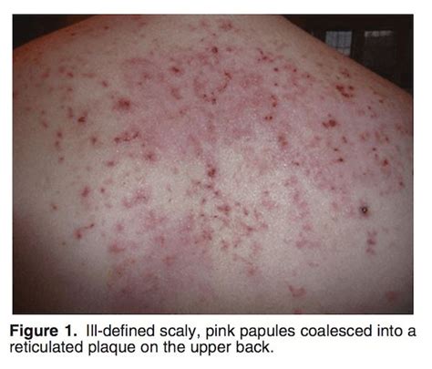 Doxycycline Archives The Keto Rash Keto Rash Skin Care Acne Acne