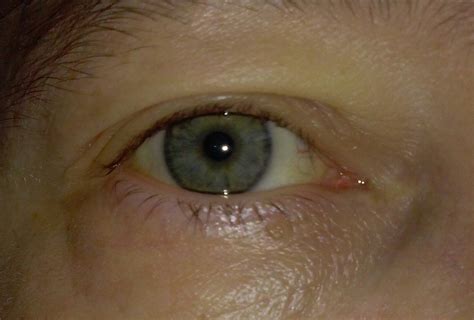 How To Get Rid Of Yellow Eyes Jaundice Teethwalls
