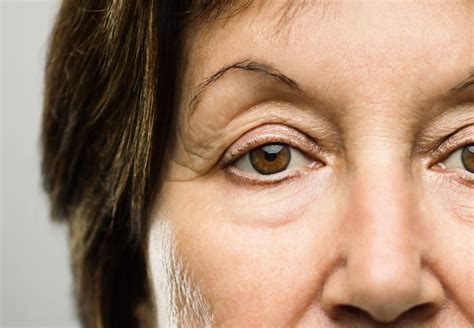 Everything You Need To Know About Droopy Eyelids Thezenblog