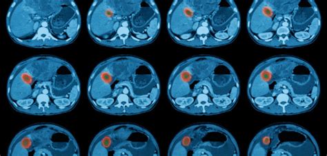 How Long Does Ct Scan Results Take Infrared For Health