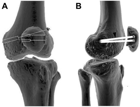 Factors Affecting The Outcomes Of Double Bundle Medial Patellofemoral