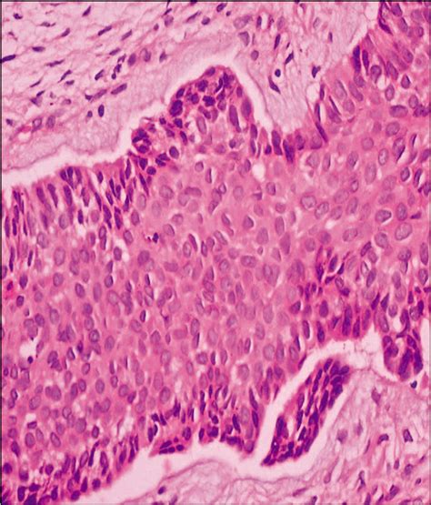 Clinicopathological Analysis Of Basal Cell Carcinoma A My Xxx Hot Girl