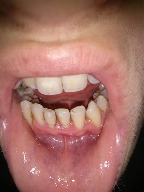 brown-edges-of-front-bottom-teeth-dentistry