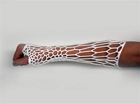 Broken Bones Here Is 3d Printed Plaster Cast Of The Future Nexpected It Cast 3d Printing