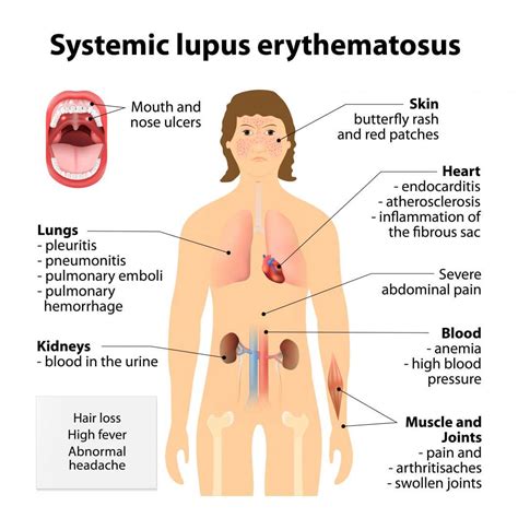 Lupus Symptoms In Women Causes Diagnosis And Treatment