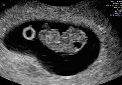 The Importance Of Private Early Pregnancy Scans For Expectant Mothers