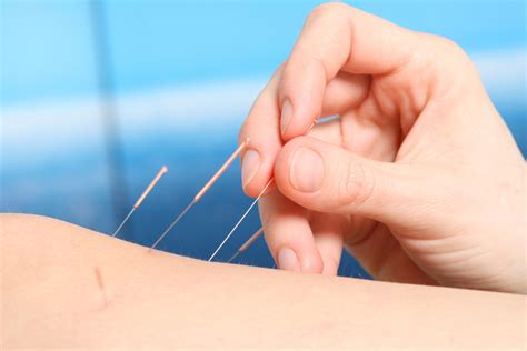dry needling faqs southern rehab and sports medicine