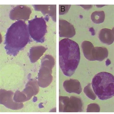 A Diffuse Large B Cell Lymphoma With Bone Marrow Bm Involvement Was