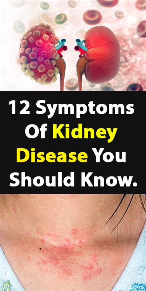 How Does Kidney Failure Make You Feel