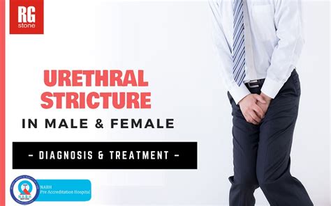 Urethral Stricture In Men And Women Diagnosis And Treatment Rg Stone