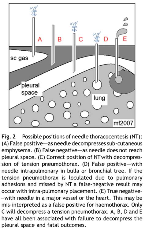 Needle Thoracocentesis For Tension Pneumothorax Northern Region