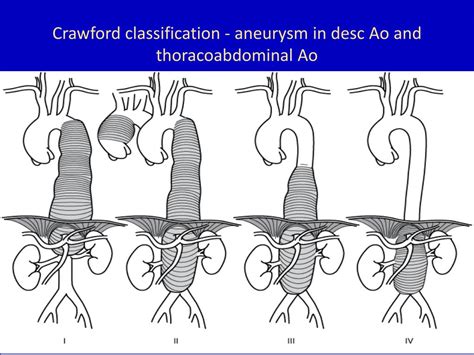 Ppt Aortic Aneurysm Management Powerpoint Presentation Free Download