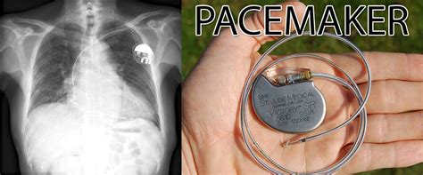 This application is not an official pacemaker product and all use is at your own risk. Hacking Fears Lead FDA To Recall Half a Million Pacemakers