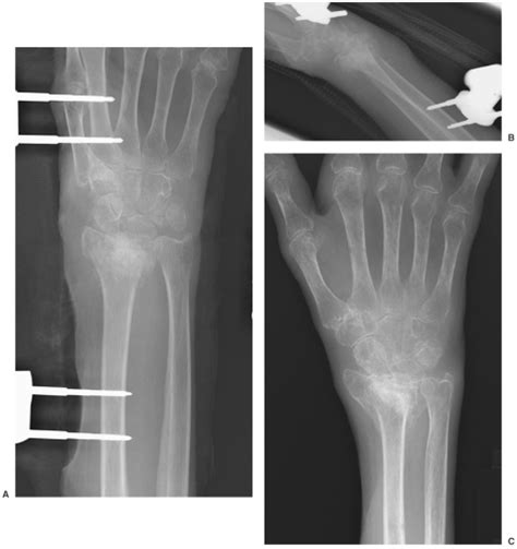 Hand And Wrist Radiology Key